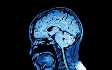 MRI scan of a human brain on a black background.